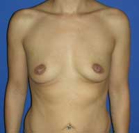 plastic surgery breast augmentation