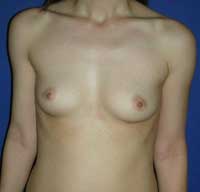 Ασυμμετρία στήθους