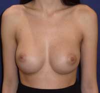 Breast implants Greece