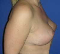 Breast lift without implants Greece