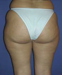 Buttocks Augmentation