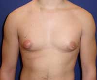 Gynecomastia, Greece