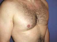 Male breast reduction, Greece