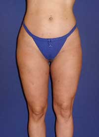 tummy liposuction, Greece