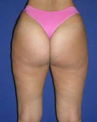 Liposuction, Thessaloniki, Greece