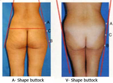 ανόρθωση γλουτών με λίπος-brazilian butt lift