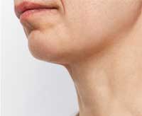 ΑBotox λαιμου