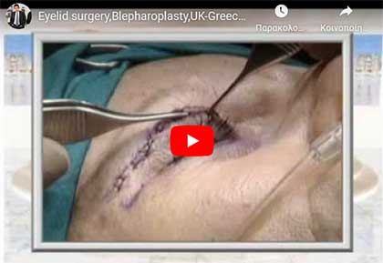 Eyelid surgery, the procedure