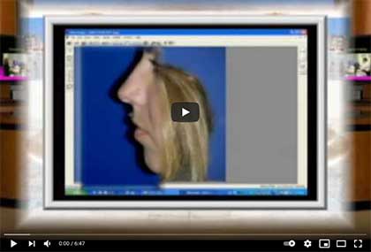 Κλινική εξέταση Ρινοπλαστική