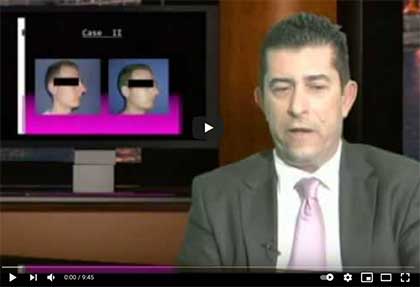 Ρινοπλαστική με γενειοπλαστική