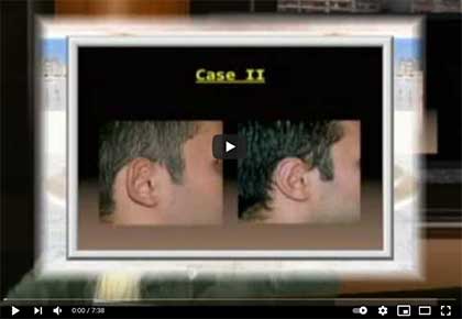 ωτοπλαστική δυσμορφίες