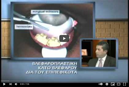 Τεχνική βλεφαροπλαστικής