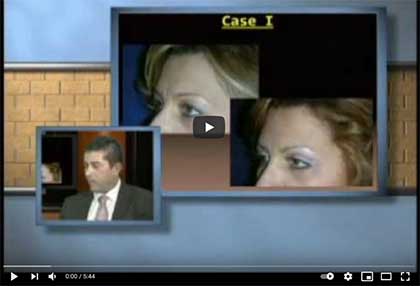 αποτέλεσμα της βλεφαροπλαστικής